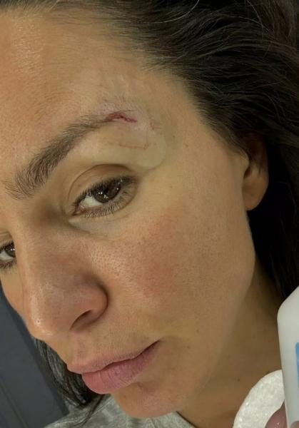 Zivert получила травму лица на йога‑практике
Zivert получила травму лица на йога‑практике